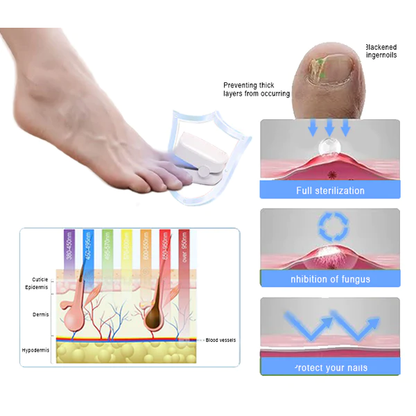 Revolutionary High-Efficiency Light Therapy Device For Toenail Diseases